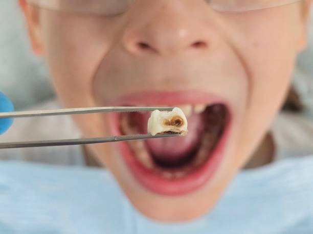 Best Emergency Tooth Extraction in North Bonneville, WA